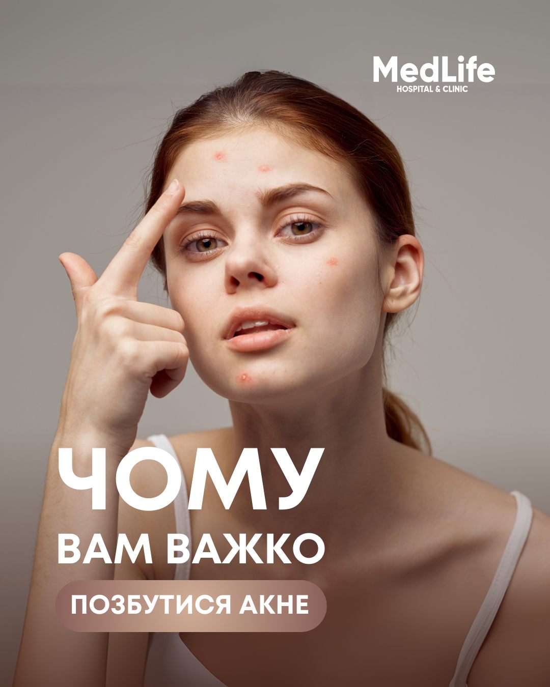 Чому вам важко позбутися акне?